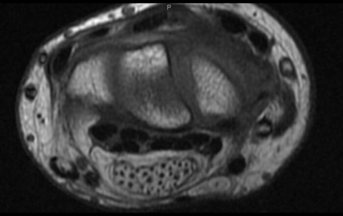 Tumores De Partes Moles Radiologia Online