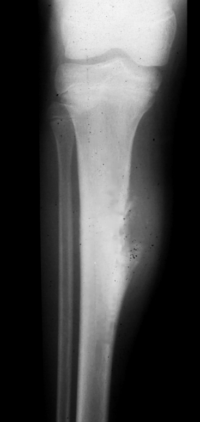 Osteossarcoma Periosteal - osteosarc periosteal osteossarcoma periosteal star