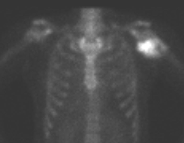 Osteossarcoma Parosteal - cintilo Osteossarcoma Parosteal - cintilo