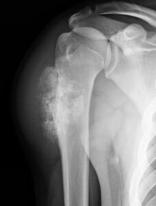 Osteossarcoma Periosteal - RX AP Osteossarcoma Periosteal - RX AP
