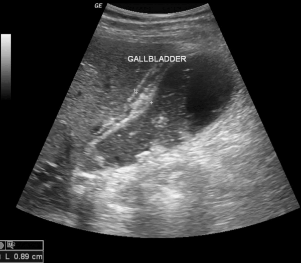 Colecistite aguda - USG acute cholecystitis Colecistite aguda - USG acute cholecystitis