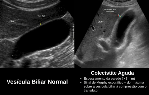 Colecistite aguda - US colecistite PTBR Colecistite aguda - US colecistite PTBR
