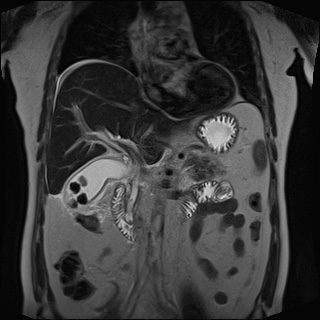 Colecistite aguda - colecistiteRM1 Colecistite aguda - colecistiteRM1