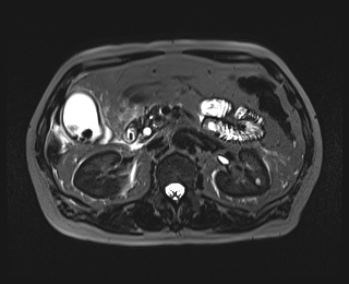 Colecistite aguda - colecistiteRM2 Colecistite aguda - colecistiteRM2