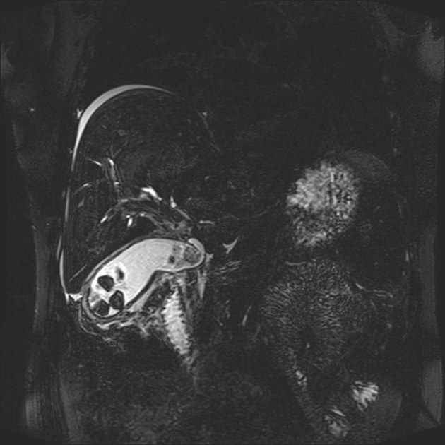 Colecistite aguda - colecistiteRM3 Colecistite aguda - colecistiteRM3