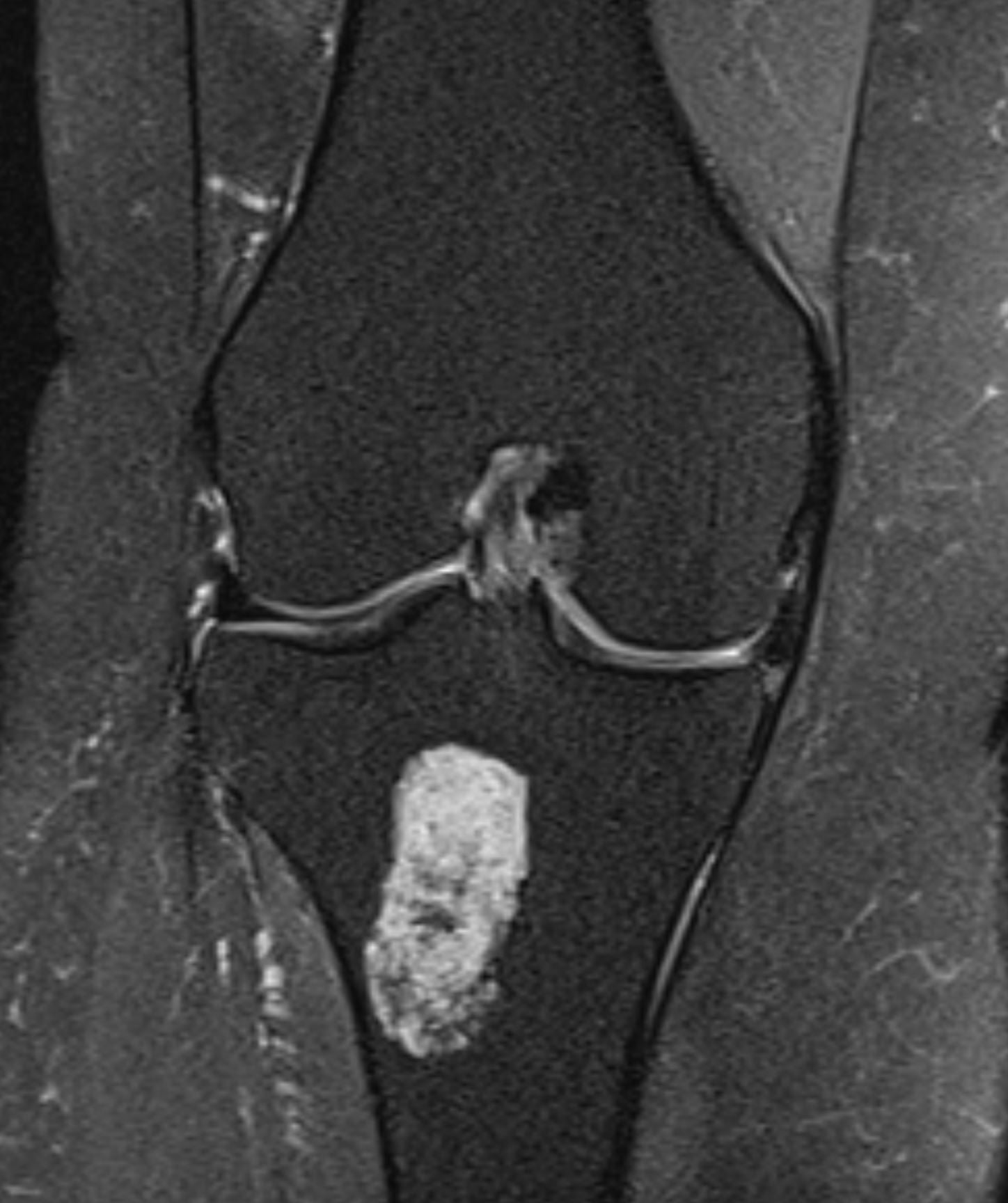 Encondroma - encondroma tibia Encondroma - encondroma tibia