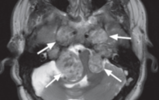 Neurofibromatose Tipo 2 - schwannomas bilat