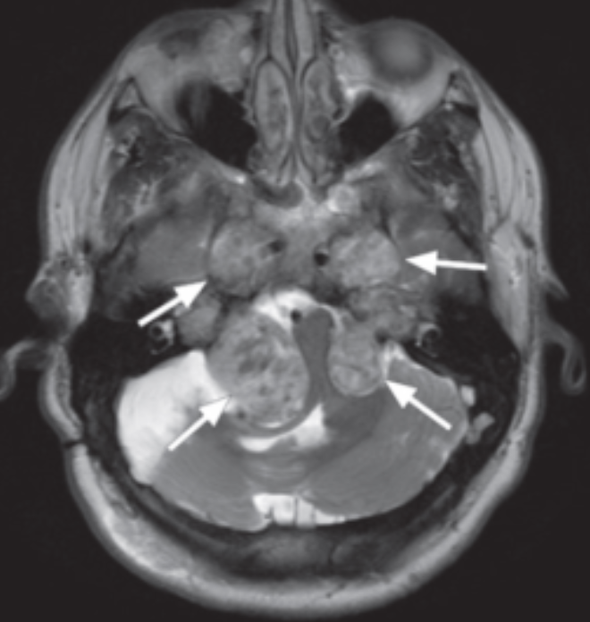 Neurofibromatose Tipo 2 - schwannomas bilat