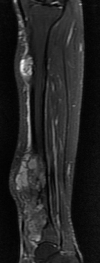 Adamantinoma - adamantinoma sag t2 Adamantinoma - adamantinoma sag t2