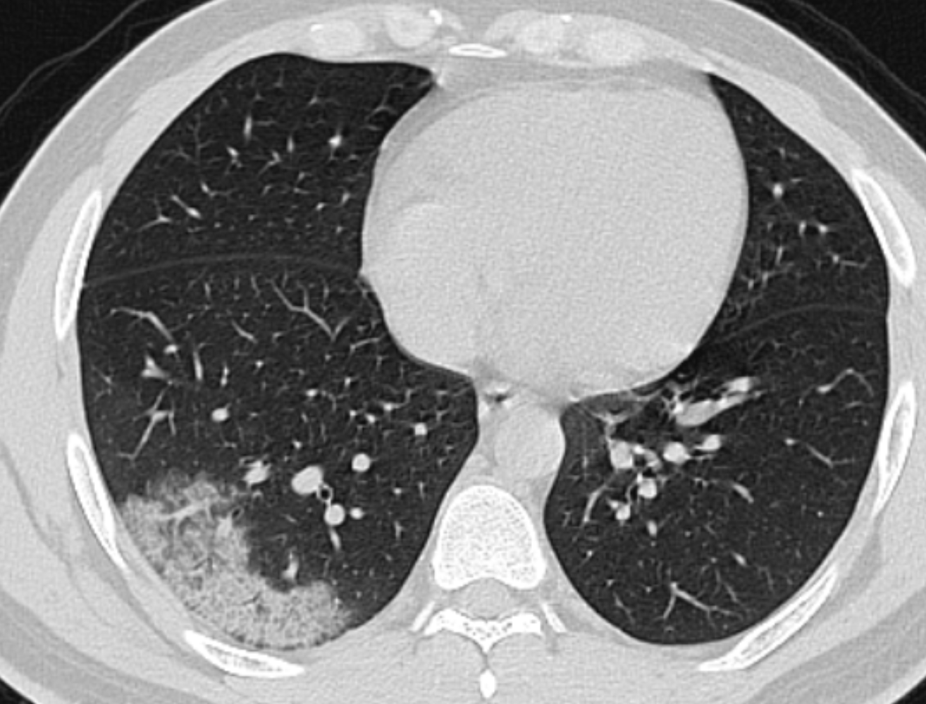 COVID-19: manifestações pulmonares - Covid 32a Axial