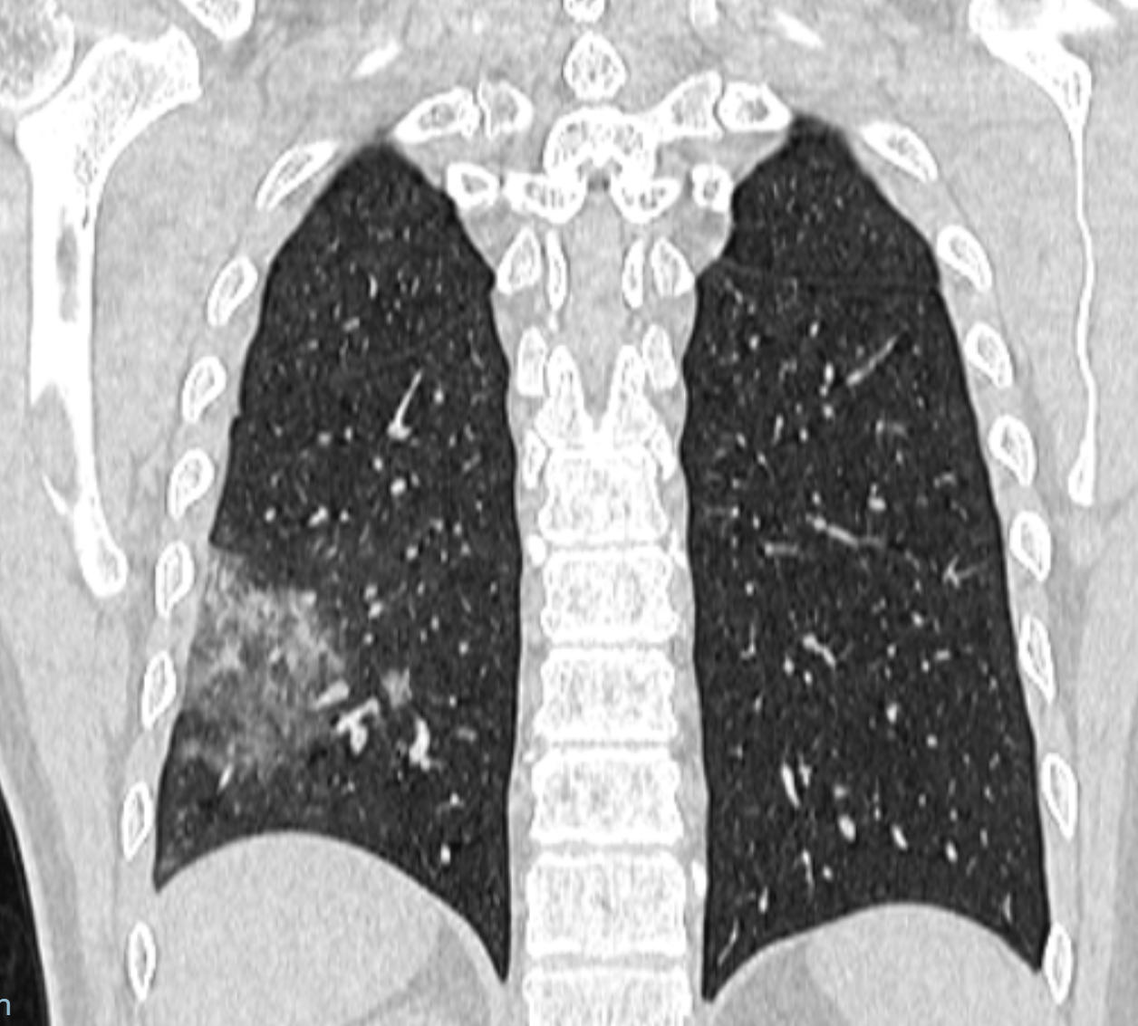 COVID-19: manifestações pulmonares - COVID 32a Coronal Covid 32a Coronal