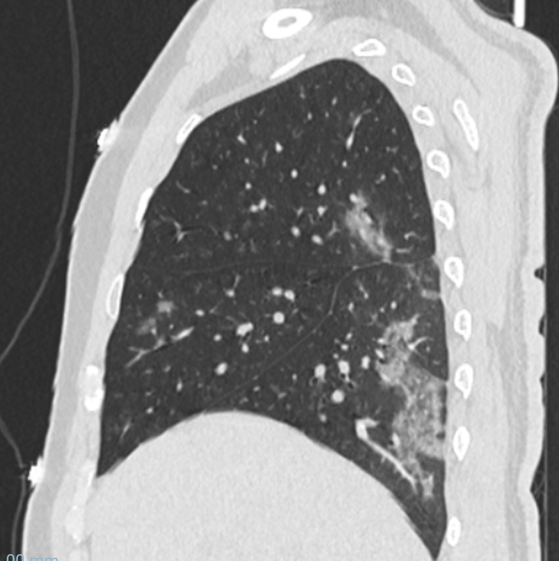 COVID-19: manifestações pulmonares - COVID 34a Sag Covid-19 34a Sag