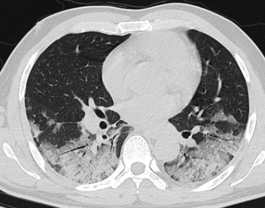 COVID-19: manifestações pulmonares - Covid 50a Axial
