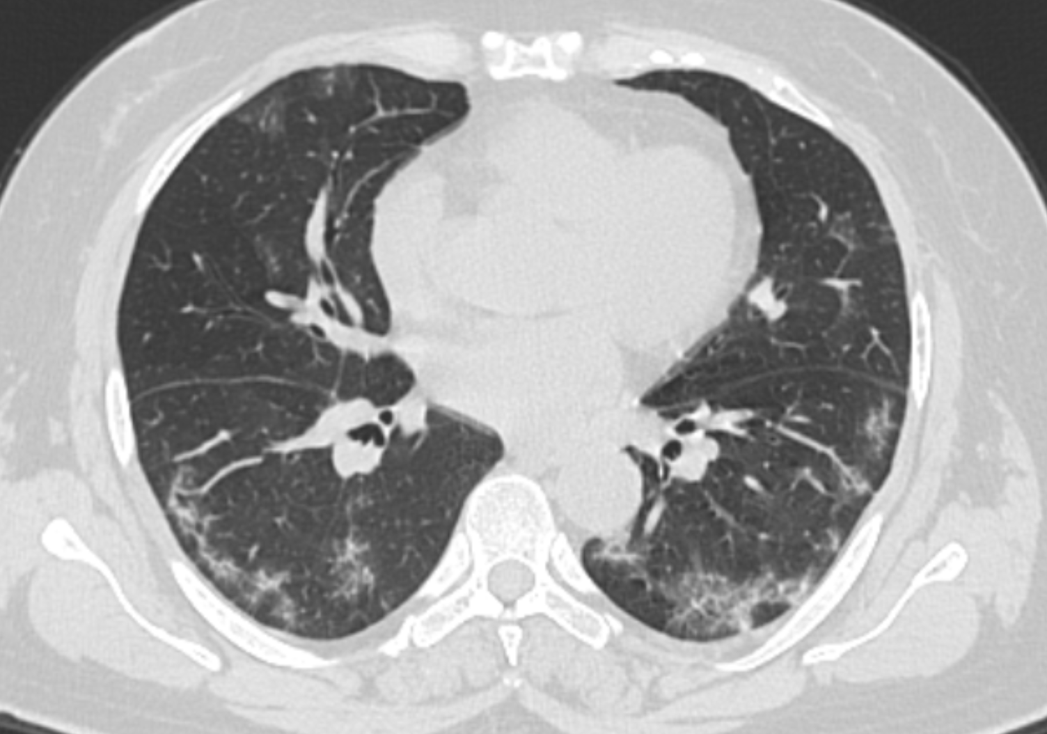 COVID-19: manifestações pulmonares - Covid 61a Axial