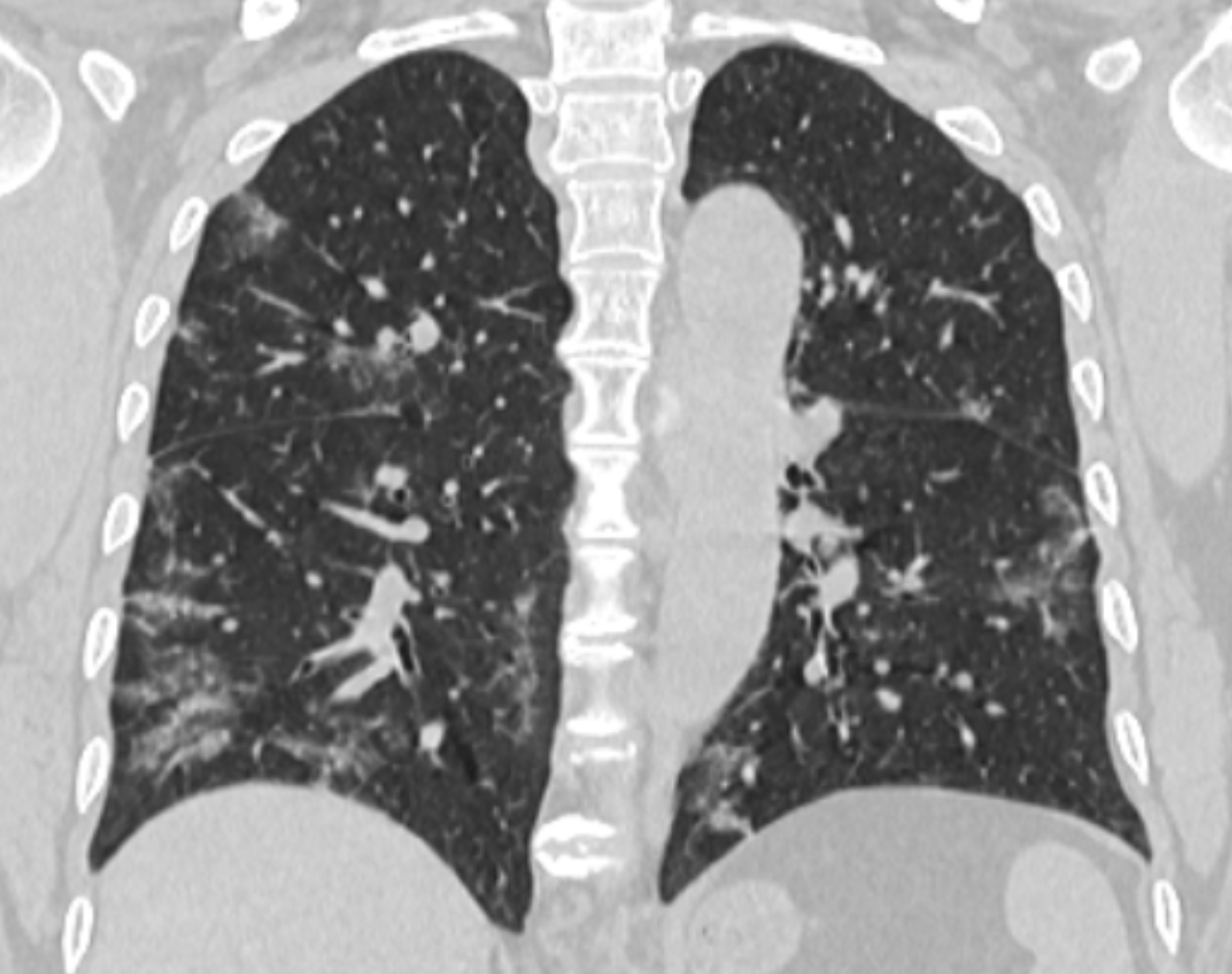 COVID-19: manifestações pulmonares - COVID 61a Coronal Covid 61a Coronal