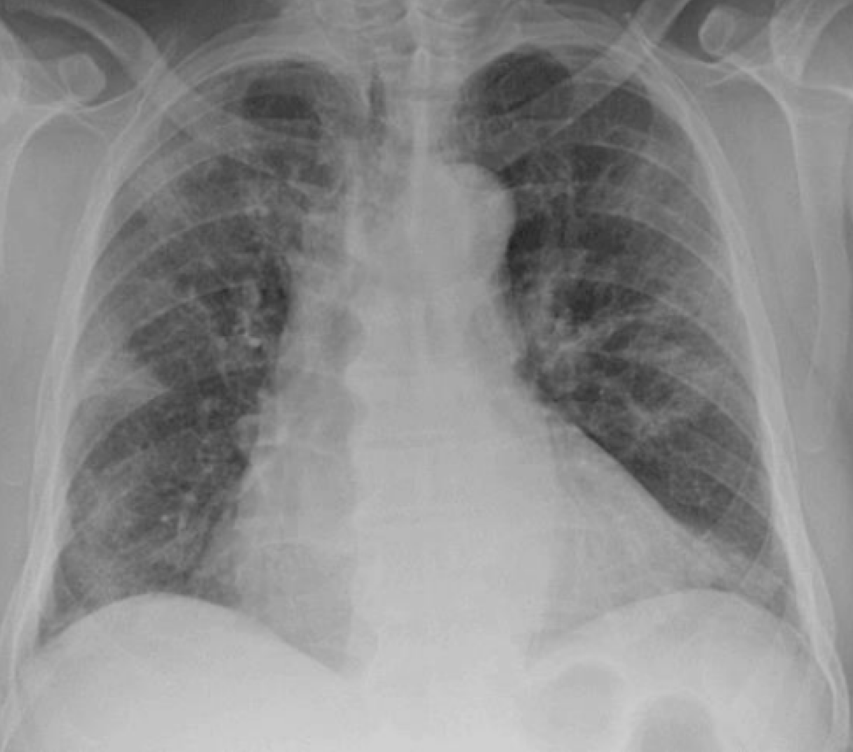 COVID-19: manifestações pulmonares - COVID RadiografiaPA Covid Radiografiapa