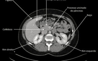 Anatomia: TC de ABDOME - 2023 09 07 191017 e1694289280982