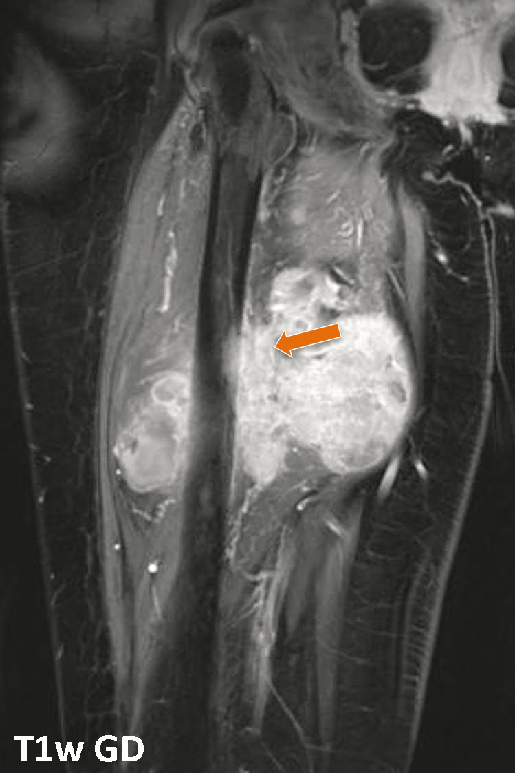 Sarcoma sinovial - 2021 06 29 213729 Sarcoma sinovial - 2021 06 29 213729