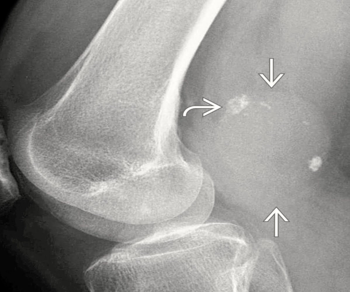 Sarcoma sinovial - 2021 06 29 215216 Sarcoma sinovial - 2021 06 29 215216