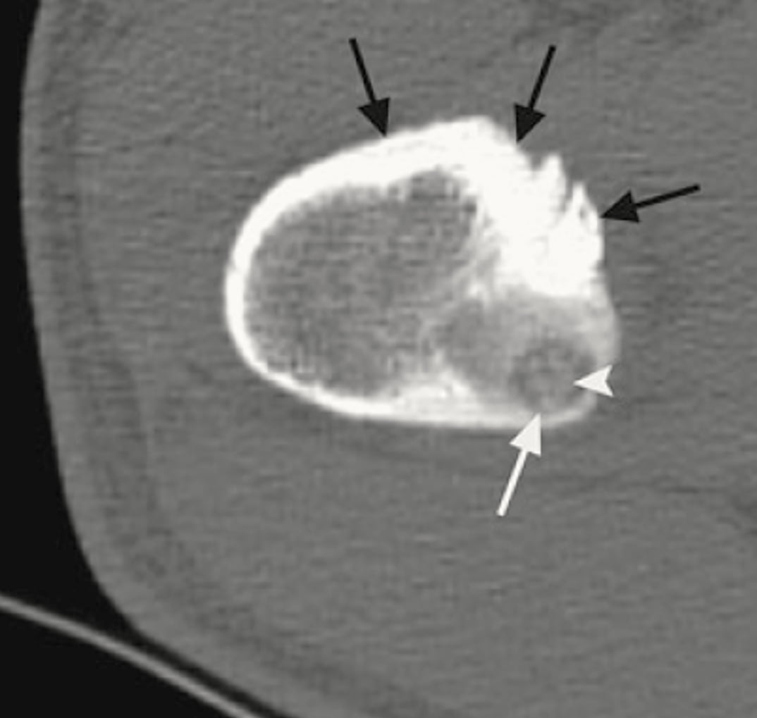 Osteoma osteoide - 2021 07 01 201821