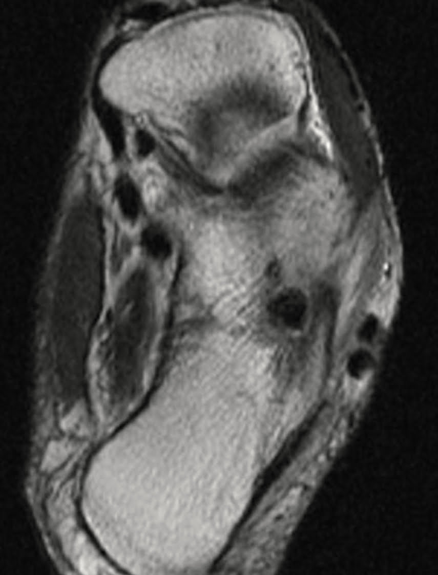 Osteoma osteoide - 2021 07 01 201855