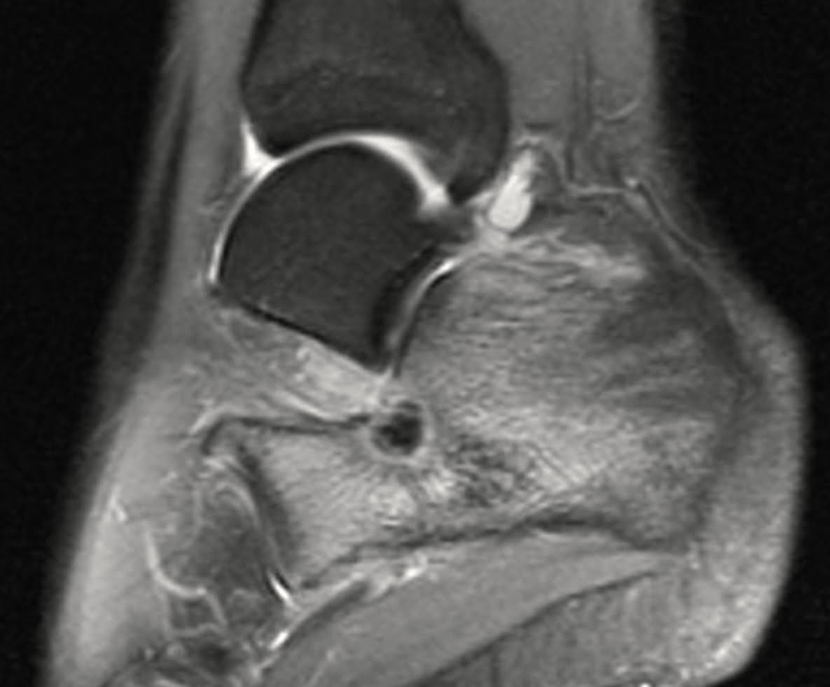 Osteoma osteoide - 2021 07 01 201901