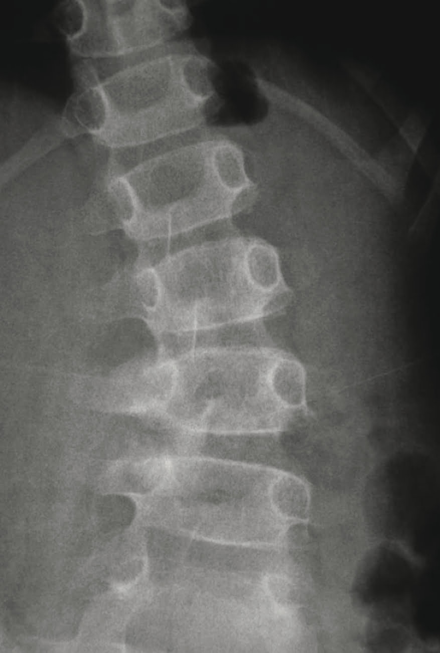 Osteoma osteoide - 2021 07 01 201915