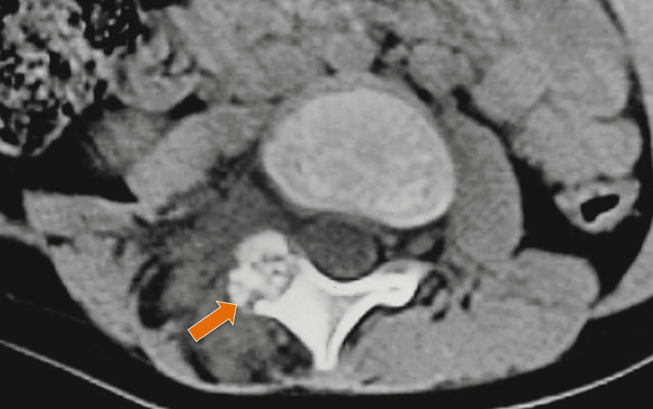 Osteoma osteoide - 2021 07 01 201922