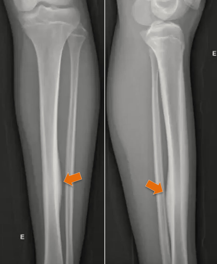 Osteoma osteoide - 2021 07 01 202028