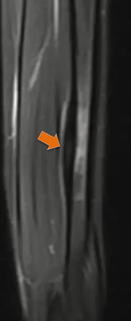 Osteoma osteoide - 2021 07 01 202034