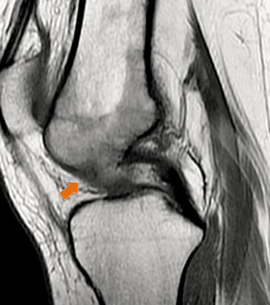 Osteoma osteoide - 2021 07 01 202211