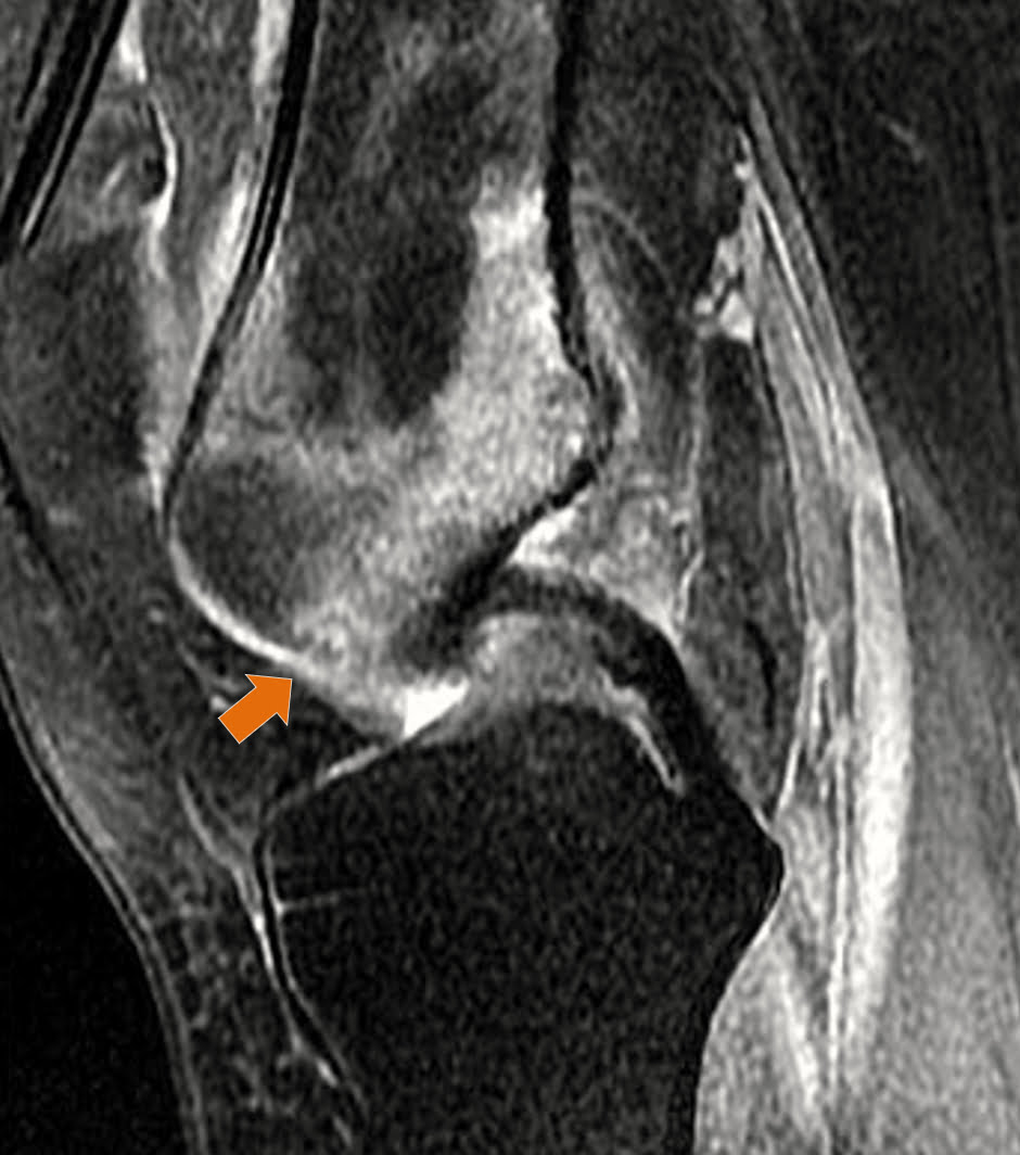 Osteoma osteoide - 2021 07 01 202219