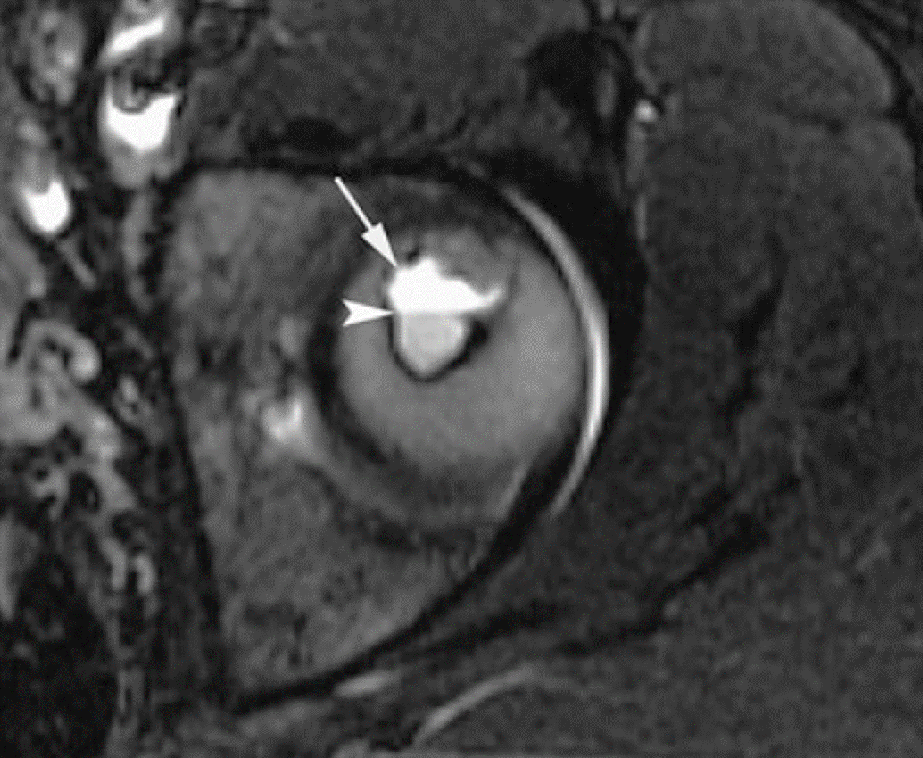 Condroblastoma - Condroblastoma COA caso 04 femur proximal 01