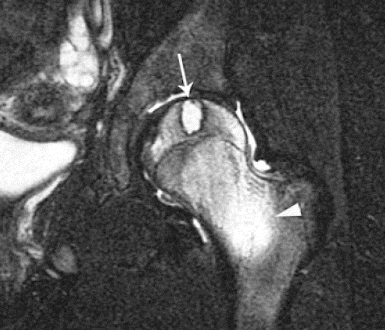 Condroblastoma - Condroblastoma COA caso 04 femur proximal 02