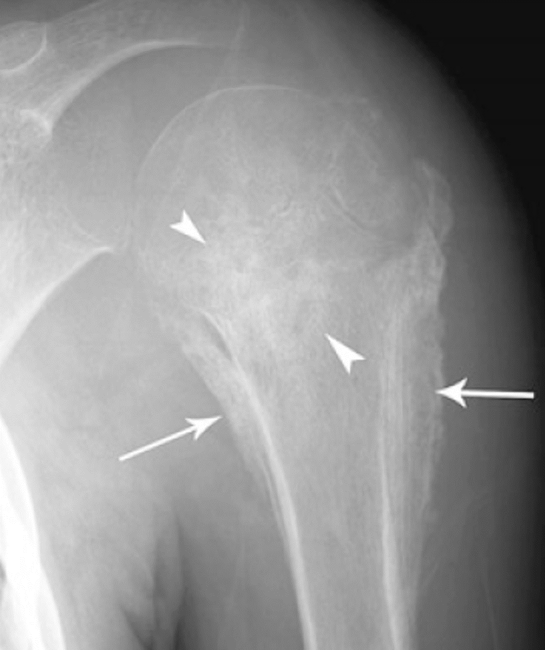 Condroblastoma - Condroblastoma aspecto agressivo caso 05 umero proximal 01