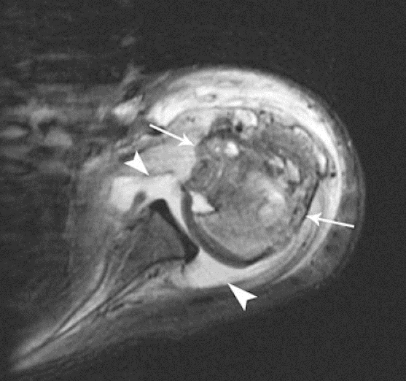 Condroblastoma - Condroblastoma aspecto agressivo caso 05 umero proximal 02