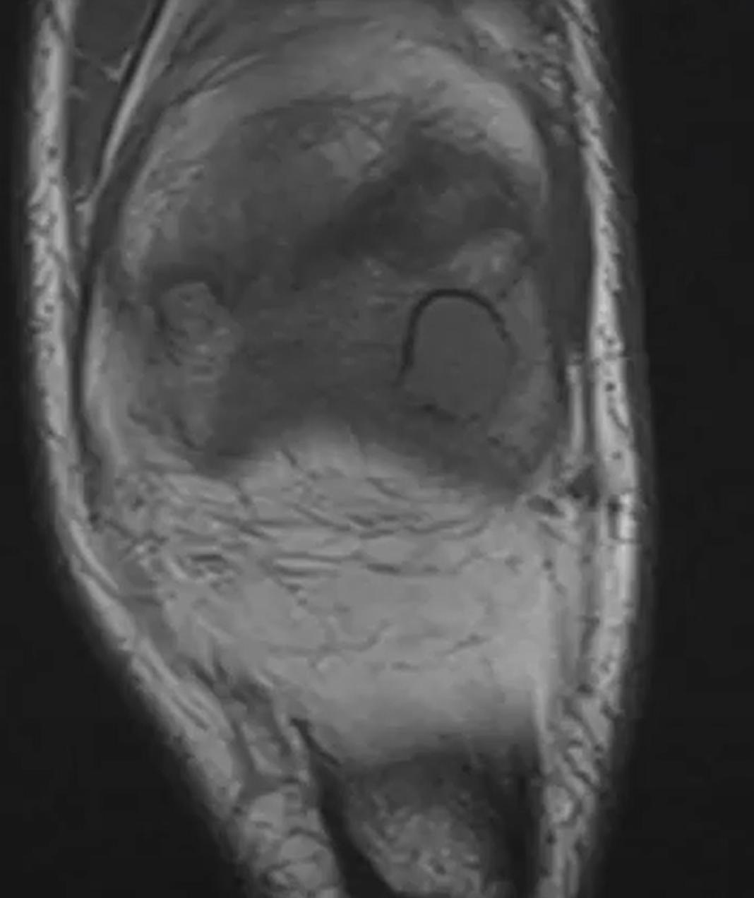 Condroblastoma - Condroblastoma caso 02 femur distal 01