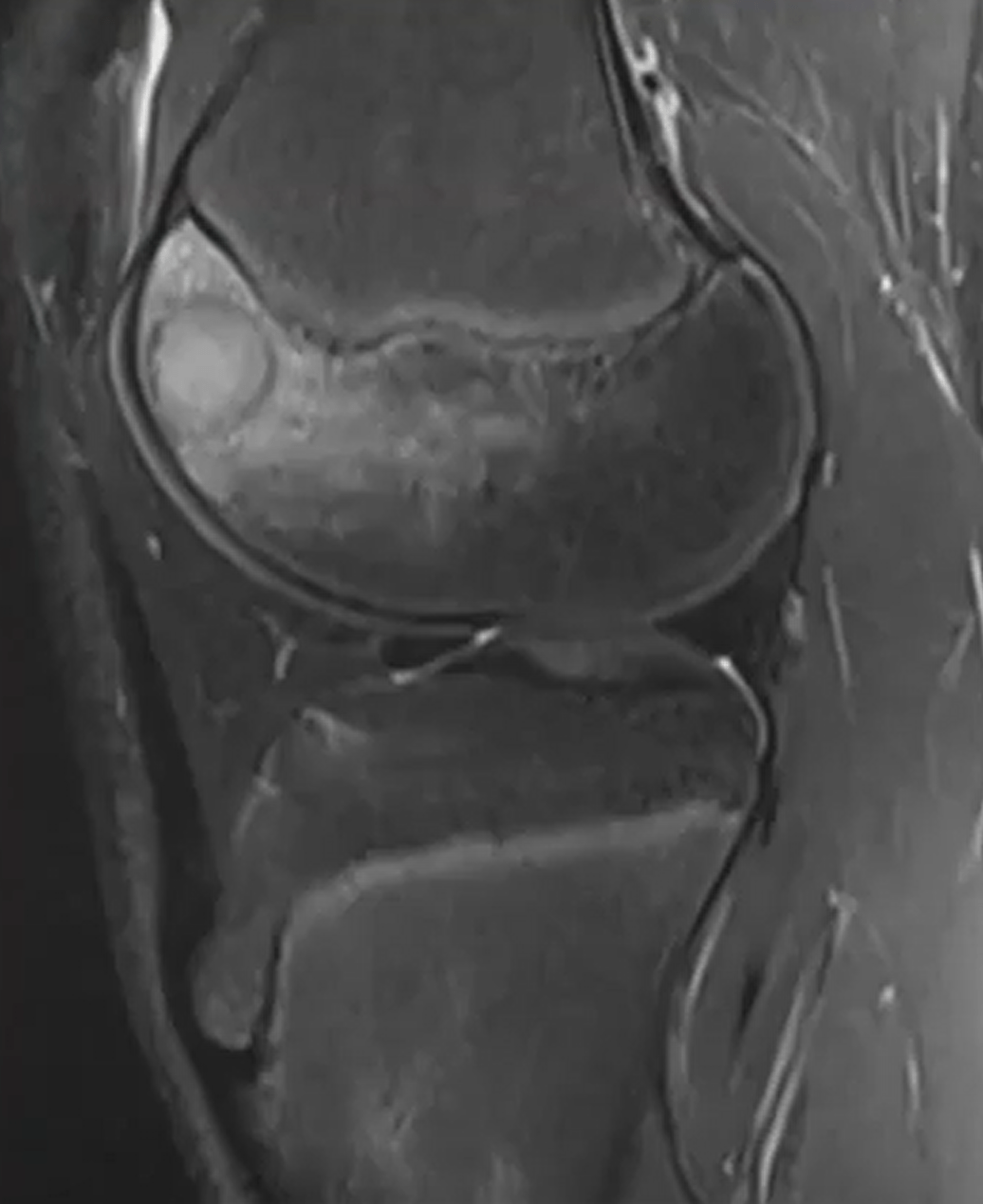 Condroblastoma - Condroblastoma caso 02 femur distal 02