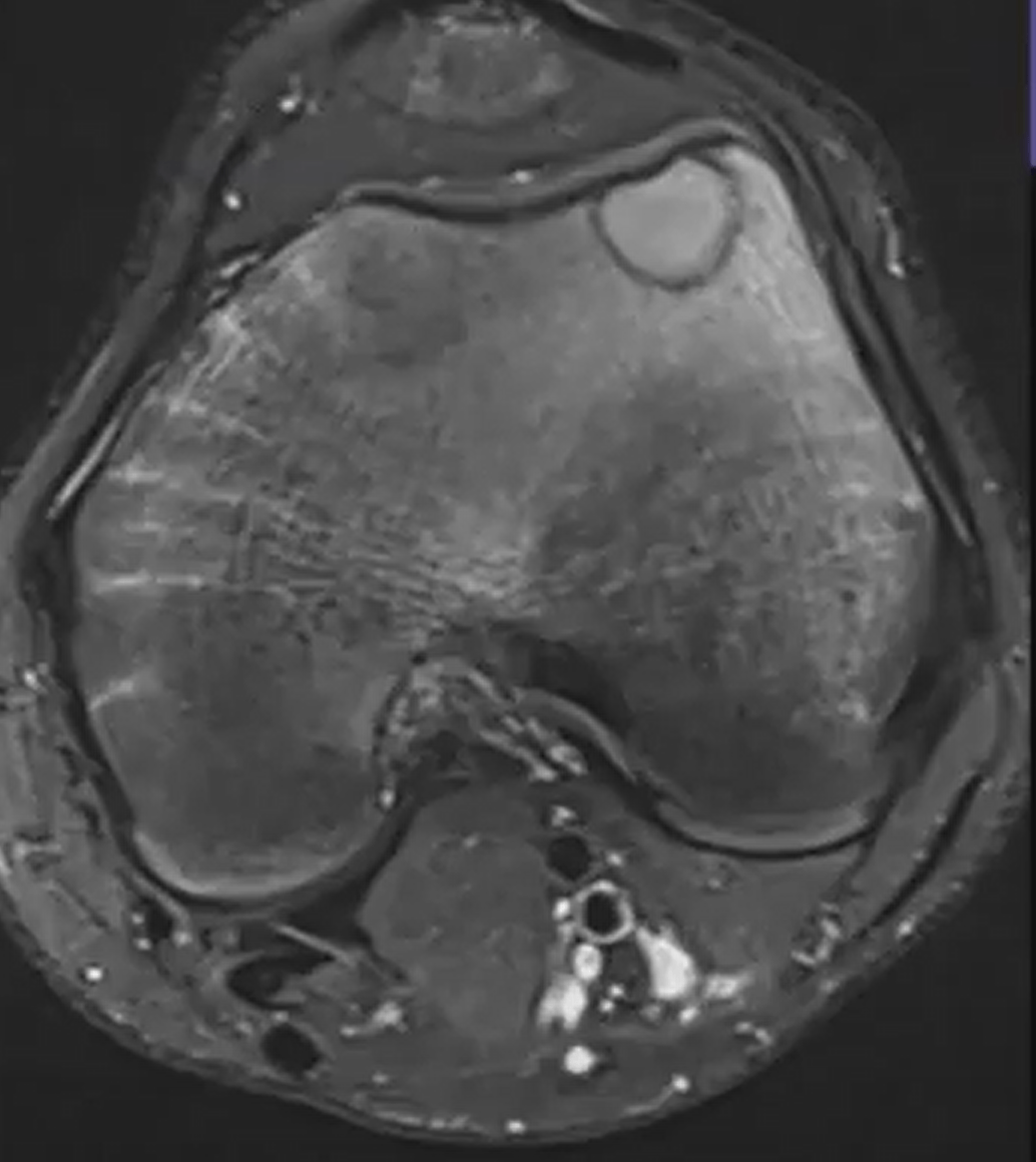 Condroblastoma - Condroblastoma caso 02 femur distal 03