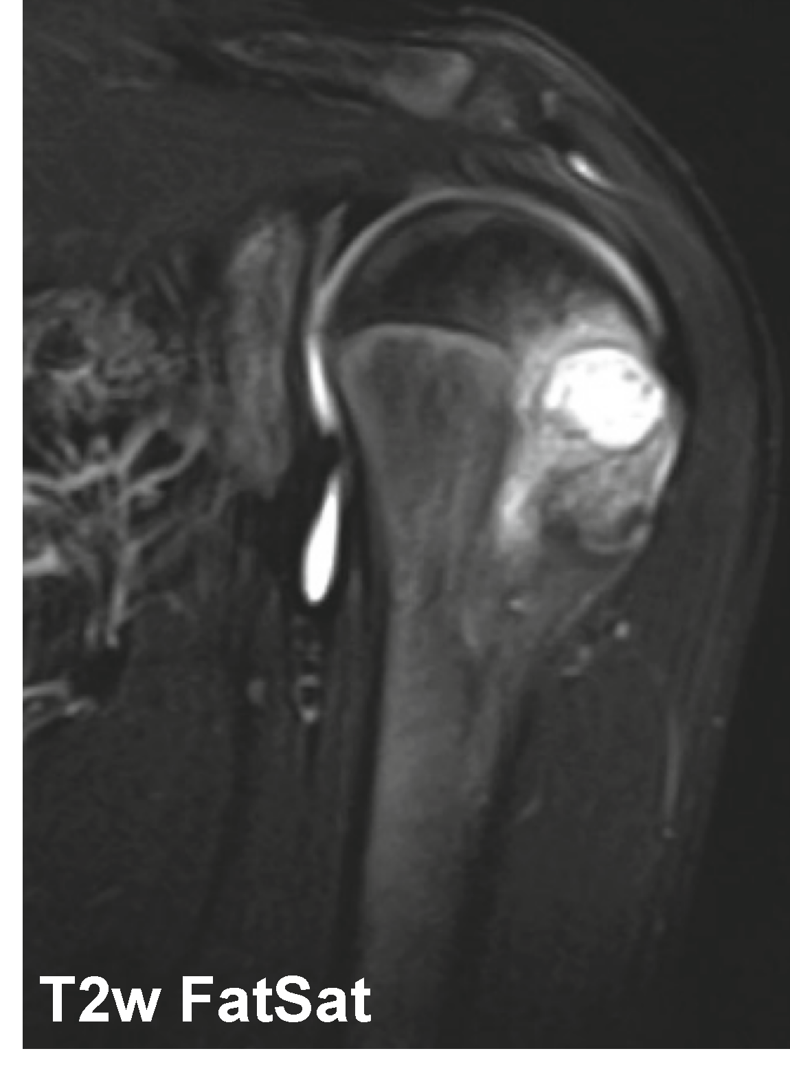Condroblastoma - Condroblastoma caso 03 umero proximal 02