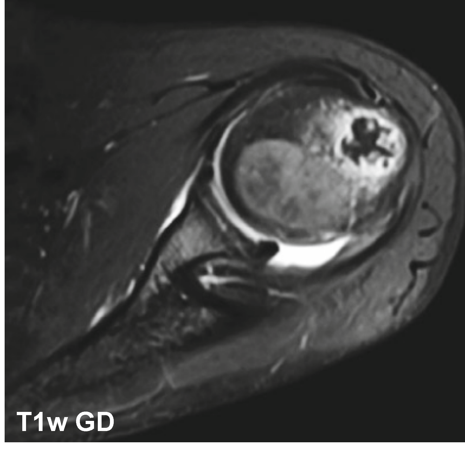 Condroblastoma - Condroblastoma caso 03 umero proximal 03