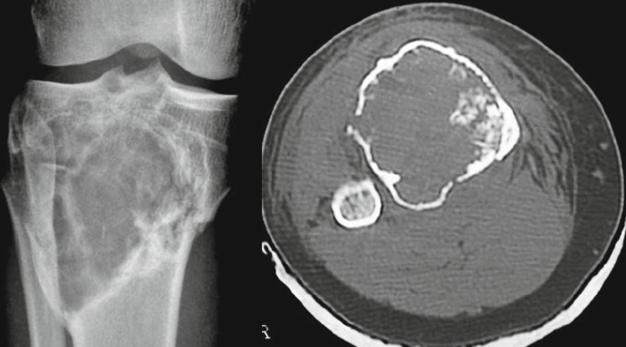 Osteoblastoma - Osteoblastoma agressivo Osteoblastoma - Osteoblastoma agressivo