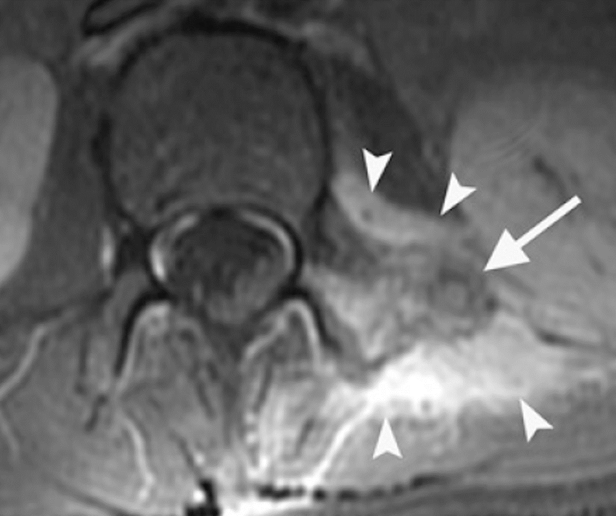Osteoblastoma - Osteoblastoma caso proc transverso similar osteoma osteoide 02 Osteoblastoma - Osteoblastoma caso proc transverso similar osteoma osteoide 02