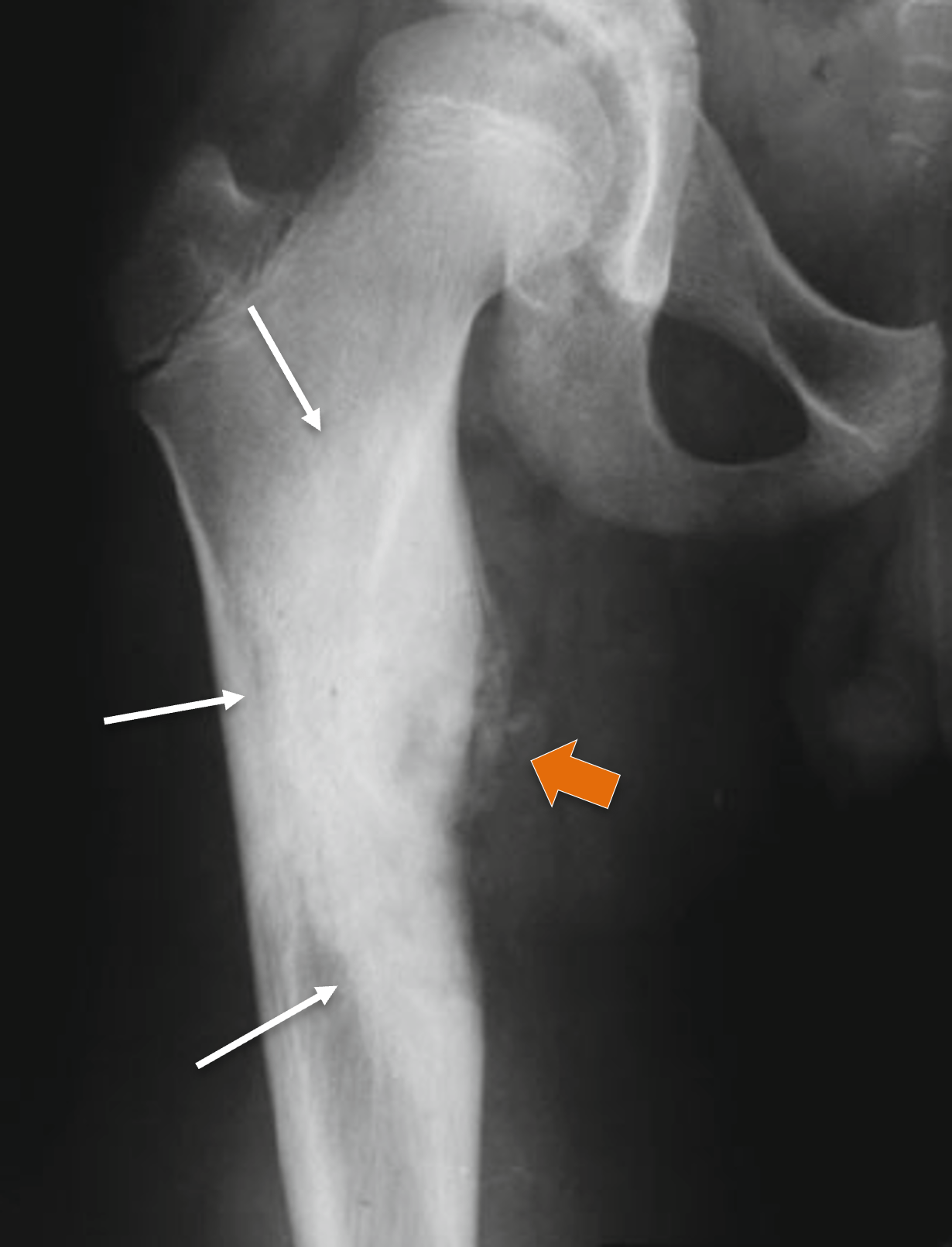 Osteoblastoma - Osteoblastoma excentrico cortical Osteoblastoma - Osteoblastoma excentrico cortical