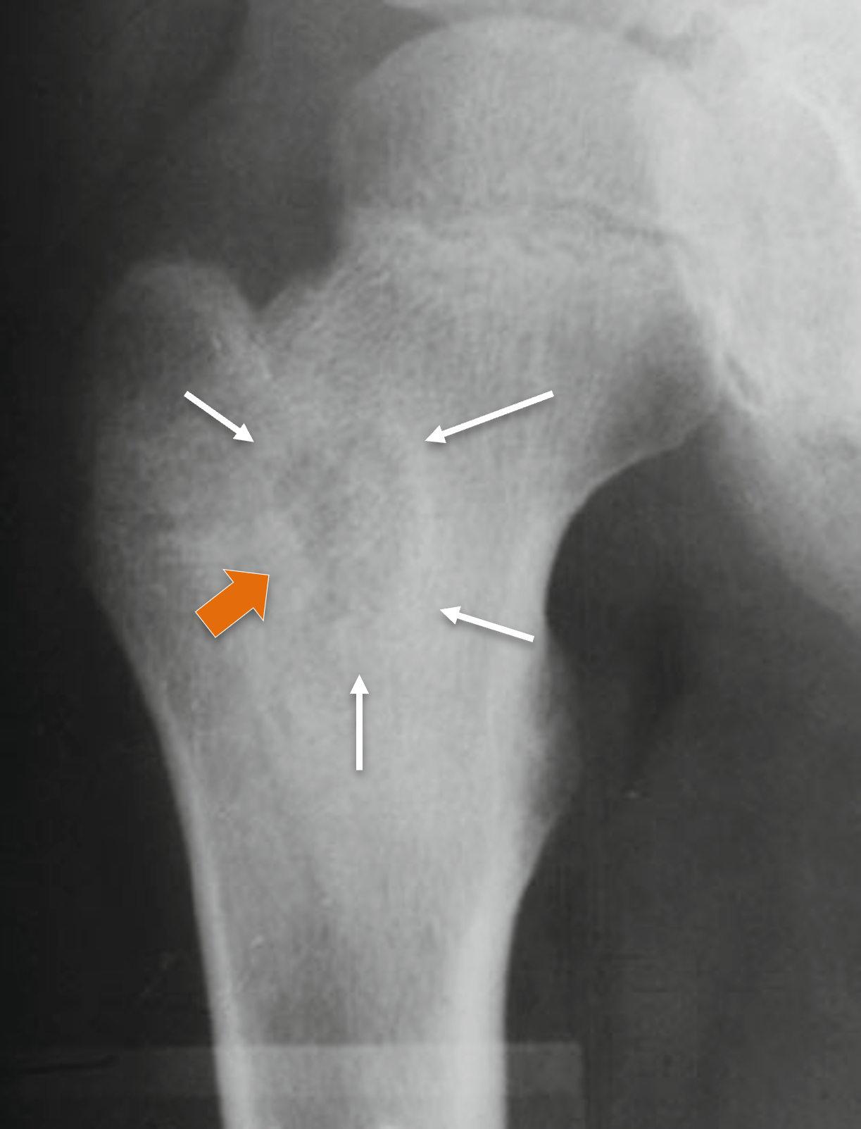 Osteoblastoma - Osteoblastoma intramedular Osteoblastoma - Osteoblastoma intramedular