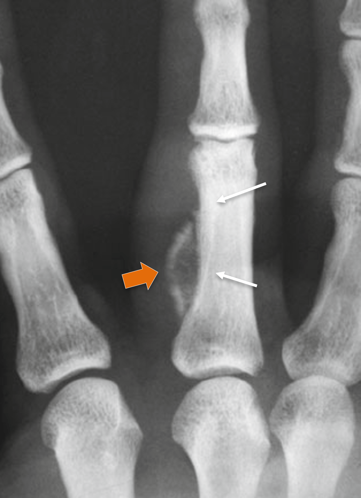 Osteoblastoma - Osteoblastoma periosteal Osteoblastoma - Osteoblastoma periosteal
