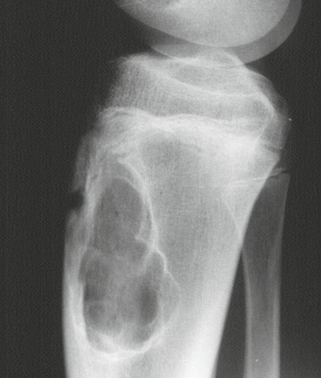 Fibroma Condromixoide - Fibroma condromixoide caso 1 01 Fibroma Condromixoide - Fibroma condromixoide caso 1 01