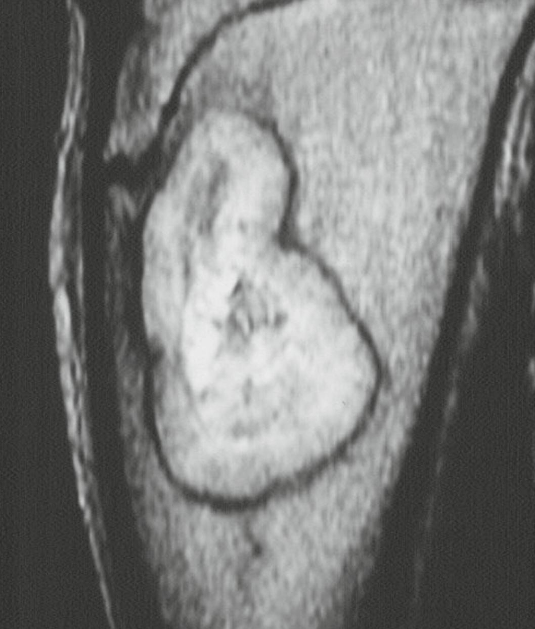 Fibroma Condromixoide - Fibroma condromixoide caso 1 02 Fibroma Condromixoide - Fibroma condromixoide caso 1 02