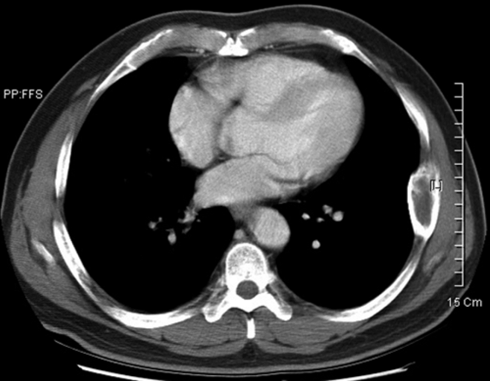 Fibroma Condromixoide - Fibroma condromixoide caso 4 Fibroma Condromixoide - Fibroma condromixoide caso 4