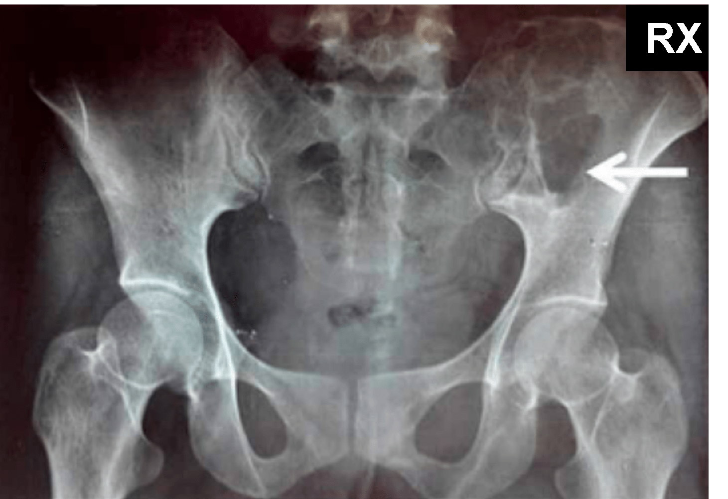 Fibroma Condromixoide - Fibroma condromixoide caso 5 01 Fibroma Condromixoide - Fibroma condromixoide caso 5 01
